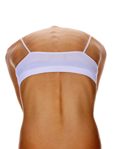 Tanned female back with numerous moles — Stock Photo, Image