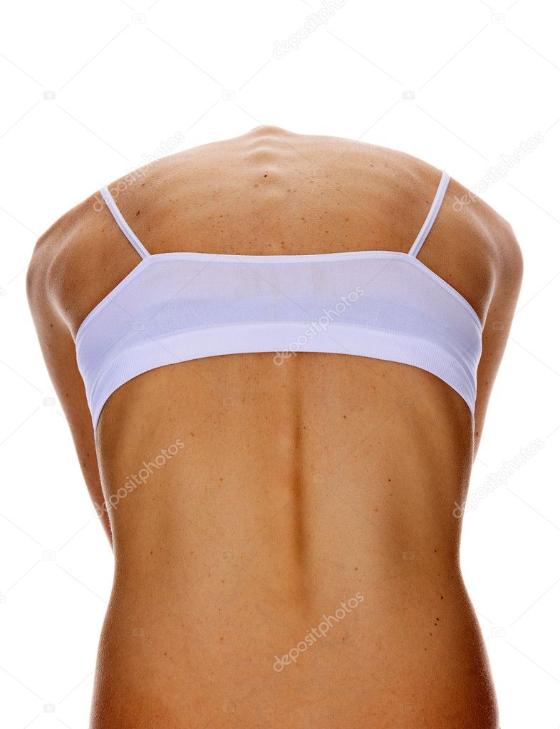 Tanned female back with numerous moles