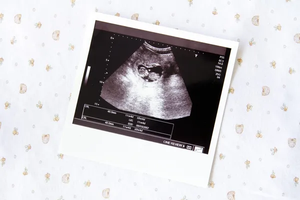 Ultrasound image for pregnancy — Stock Photo, Image