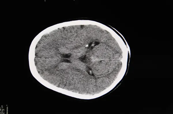 Gehirn-CT — Stockfoto