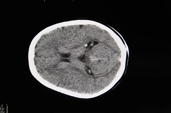 脳CT ロイヤリティフリーのストック写真