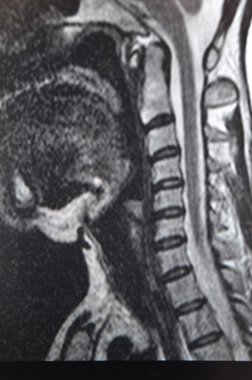 Spine mri clipart