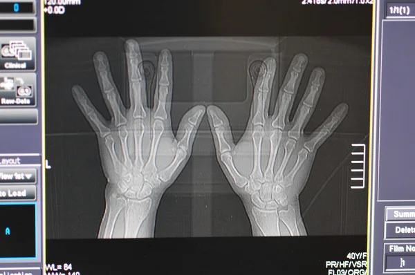 Hand-Röntgen — Stockfoto
