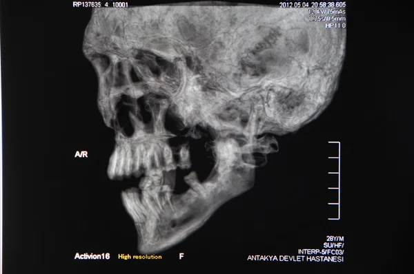 두개골 ct — 스톡 사진