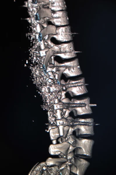 척추 ct — 스톡 사진