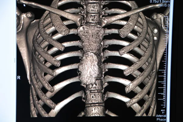 척추 ct — 스톡 사진