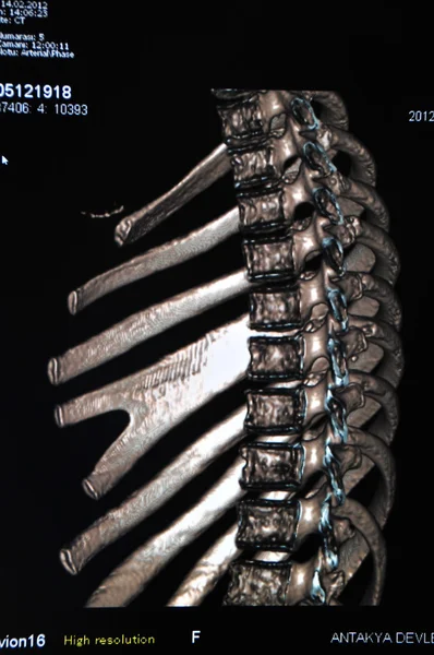 Spine ct — Stock Photo, Image