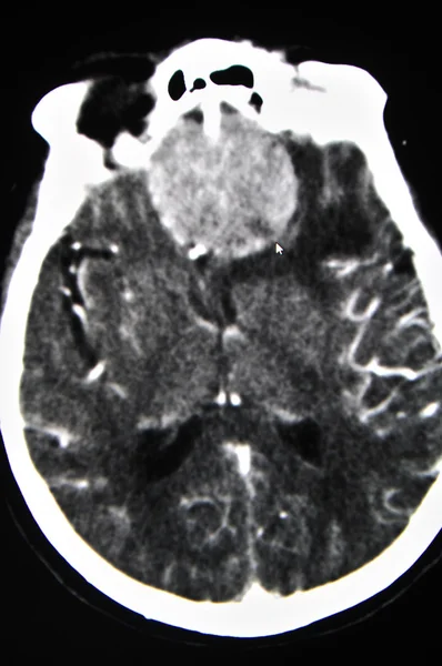 Hjärnan CT — Stockfoto