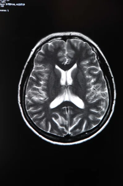 МРТ мозку — стокове фото