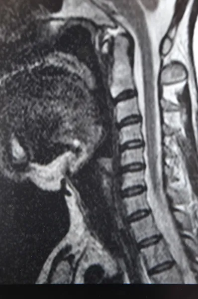 脊椎 mri — ストック写真