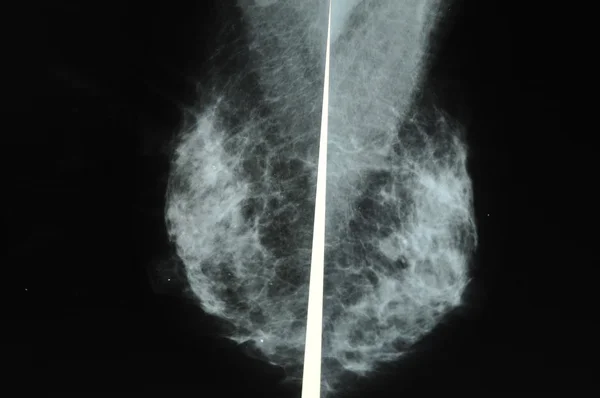 Mammografi — Stockfoto