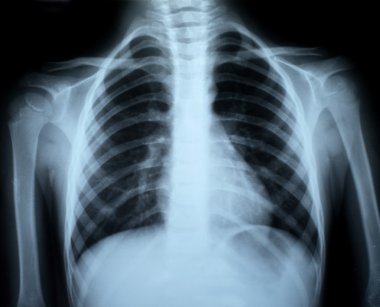 Chest xray clipart