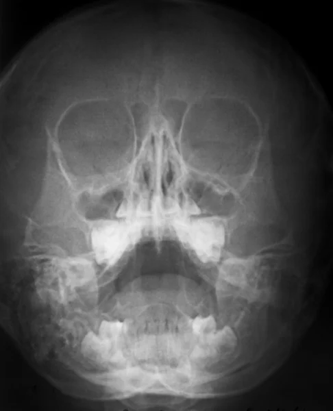 stock image X-ray skull