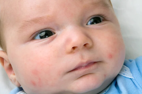 Baby acne op pasgeboren — Stockfoto