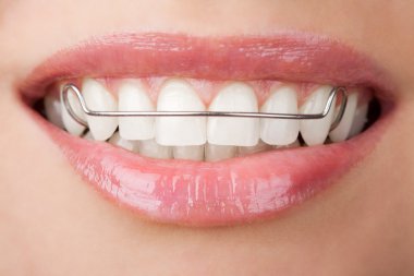 Teeth with retainer clipart