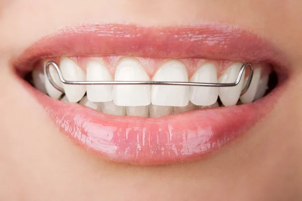 Dentes com retentor — Fotografia de Stock