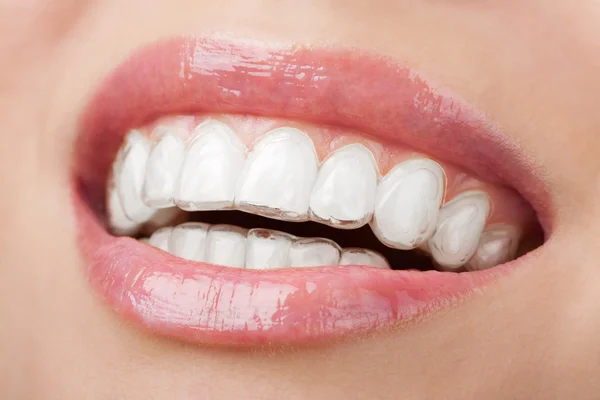 Tänder med tandblekning bricka — Stockfoto