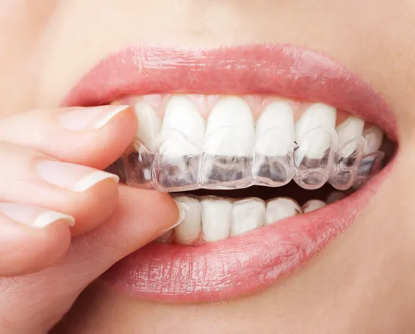 Teeth with whitening tray — Stock Photo, Image