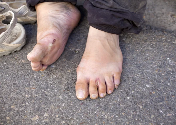 An injured foot — Stockfoto