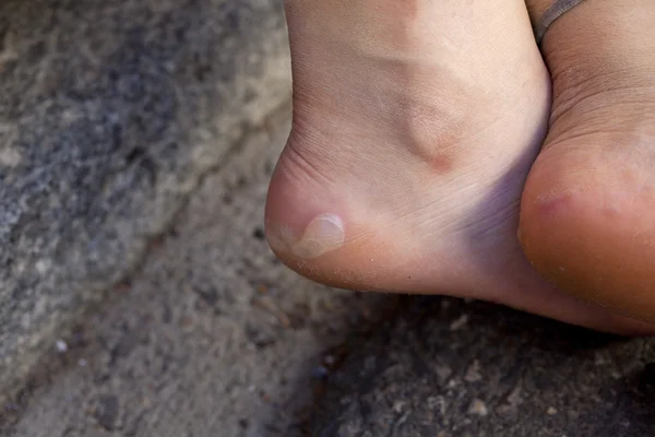 Un piede ferito — Foto Stock