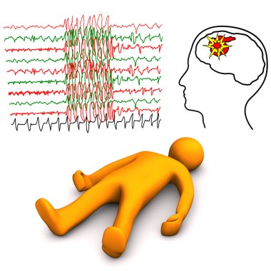 Apoplectic And Epileptic Stroke clipart