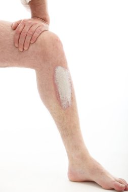 Psoriasis on leg clipart