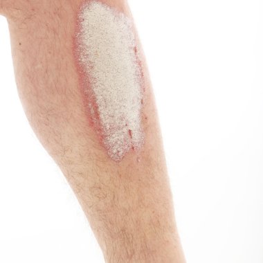 Psoriasis or psoriasis on lower legs - close up clipart