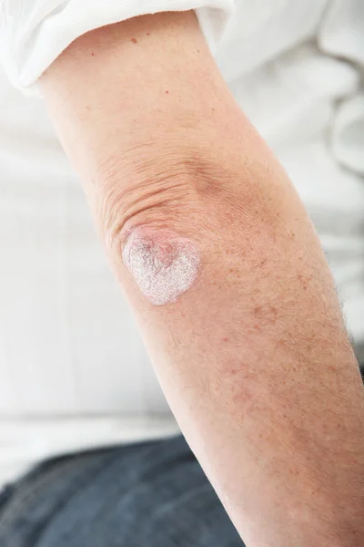 Psoríase pele ou decidir sobre o cotovelo — Fotografia de Stock