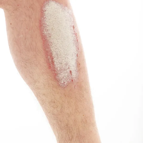 psoriasis melk
