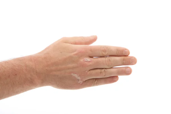 Psoriasis on the hands and under fingernails — Stock Photo, Image