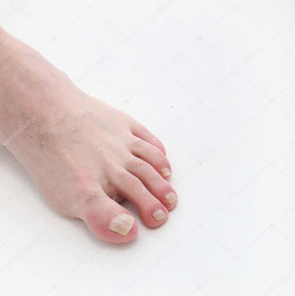 Psoriasis of the toenails with text space