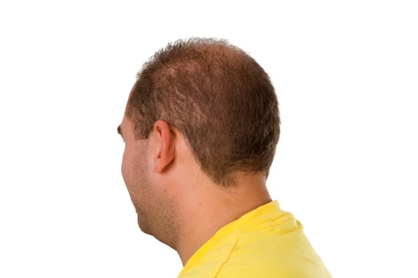 Молодий чоловік з проблемою волосся — стокове фото
