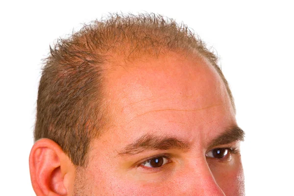 Молодой человек с проблемой волос — стоковое фото