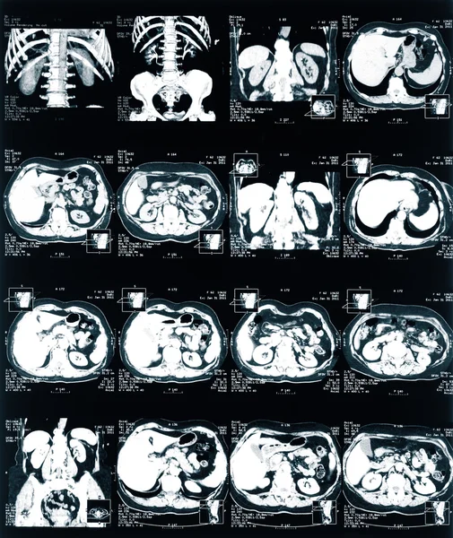 骨盆和脊柱的 x 射线 — 图库照片