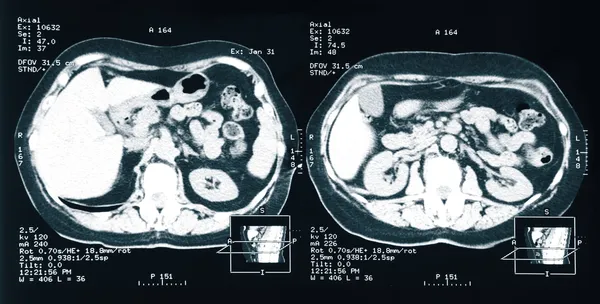МРТ. Рентгенівський знімок нирки людини — стокове фото