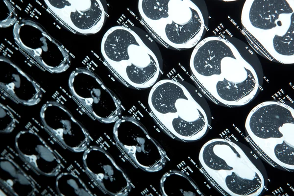 RMN del cerebro humano — Foto de Stock