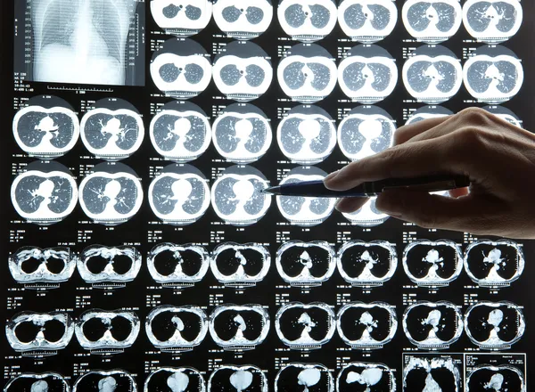 MRI van menselijke hersenen — Stockfoto