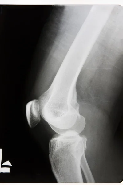 X-rayed the leg and knee — Stock Photo, Image