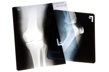 X-rayed the leg and knee clipart