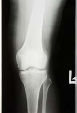 X-rayed the leg and knee clipart
