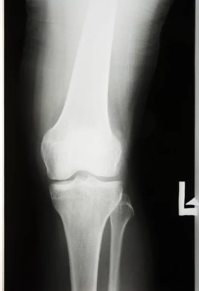X-rayed the leg and knee — Stock Photo, Image