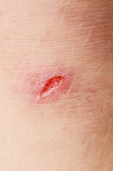 Cicatriz en la piel — Foto de Stock