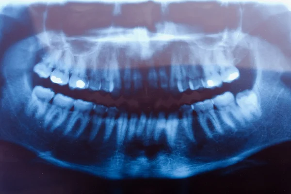 Zubní rentgen — Stock fotografie