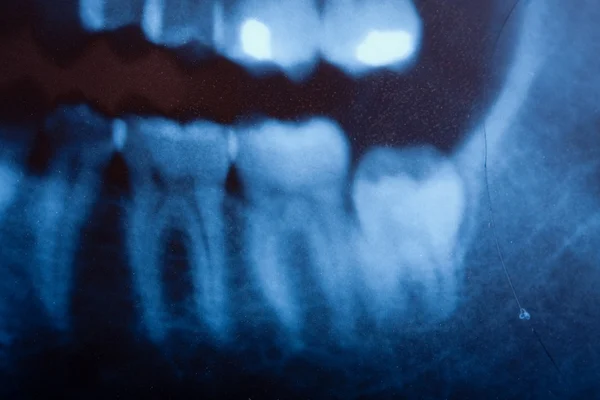 Dental röntgen — Stockfoto