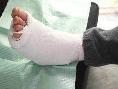 Diabetic foot injury clipart