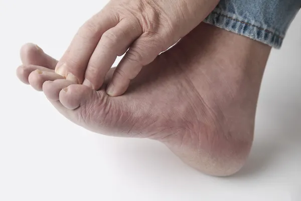 Homem com coceira nos dedos dos pés — Fotografia de Stock