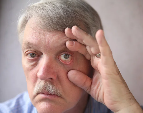 Occhi iniettati di sangue in un uomo anziano — Foto Stock