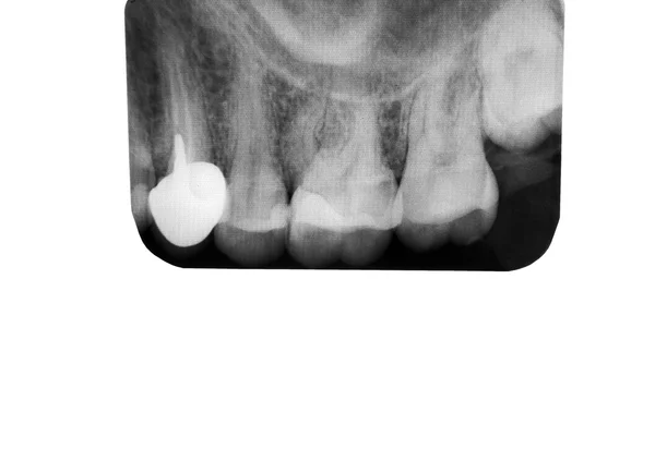 牙科 x 射线 — 图库照片