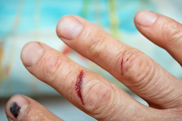 Травмированные пальцами руки — стоковое фото