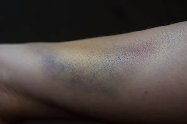 Bruised arm — Stock Photo, Image